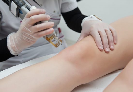 Benefits of Laser Hair Removal
